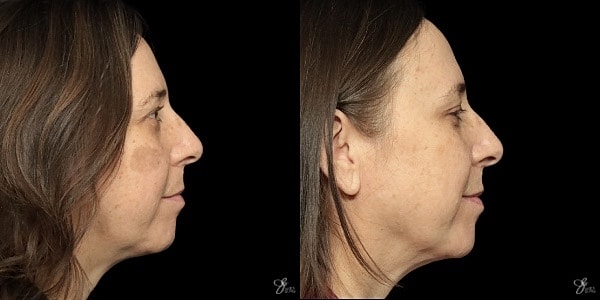 Before and after IPL profile comparison of a woman.