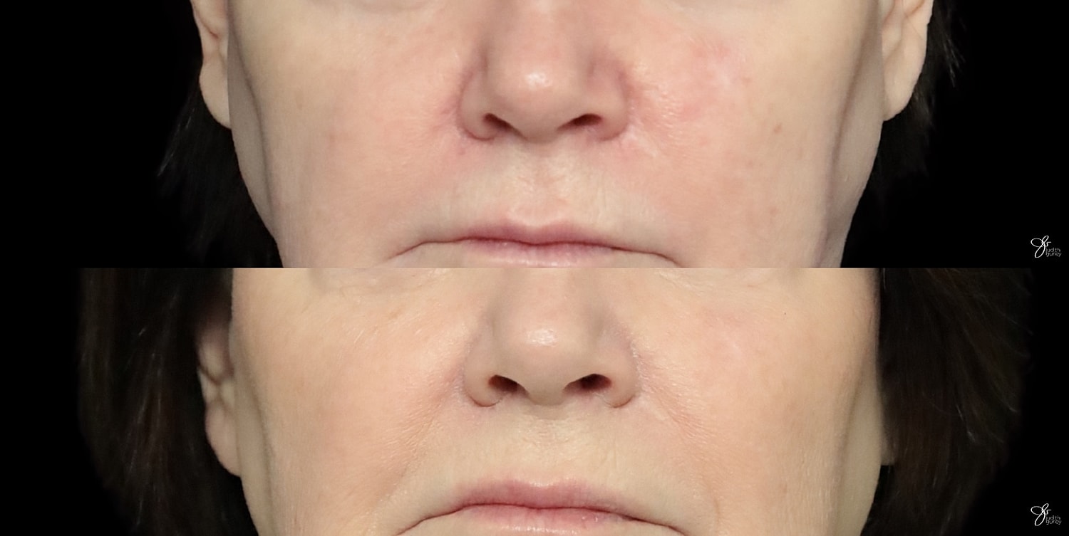 Facial close-up showing skin texture changes.