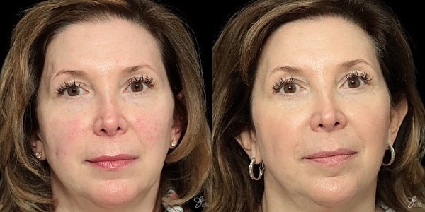 Before and after skincare treatment comparison image.