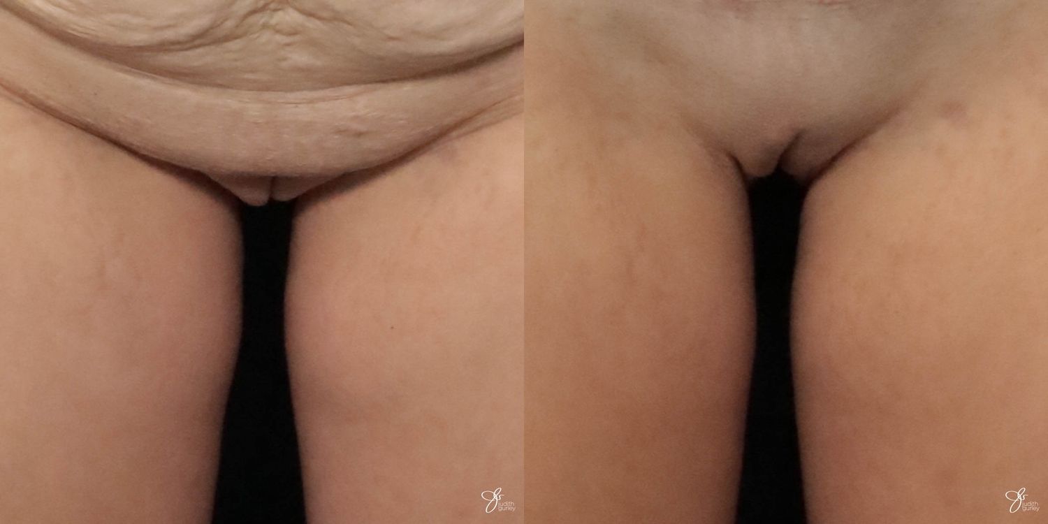 Labiaplasty Before & After