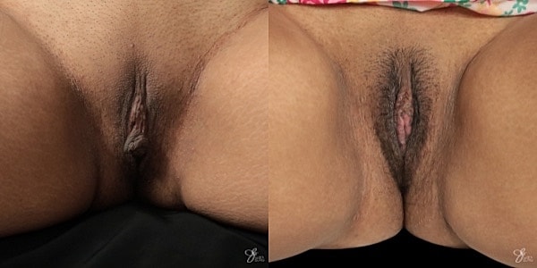 Labiaplasty Before & After