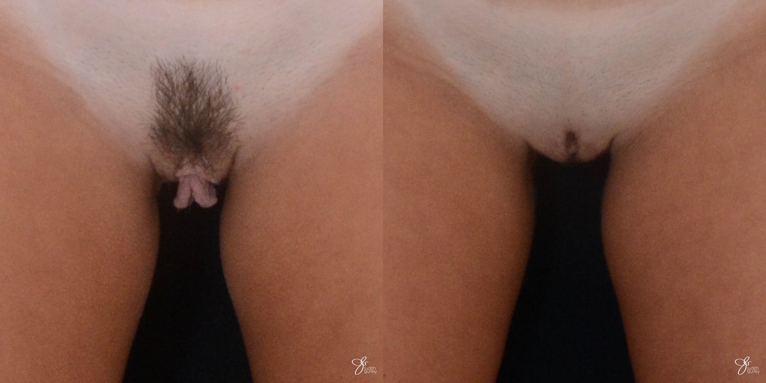 Labiaplasty Before & After
