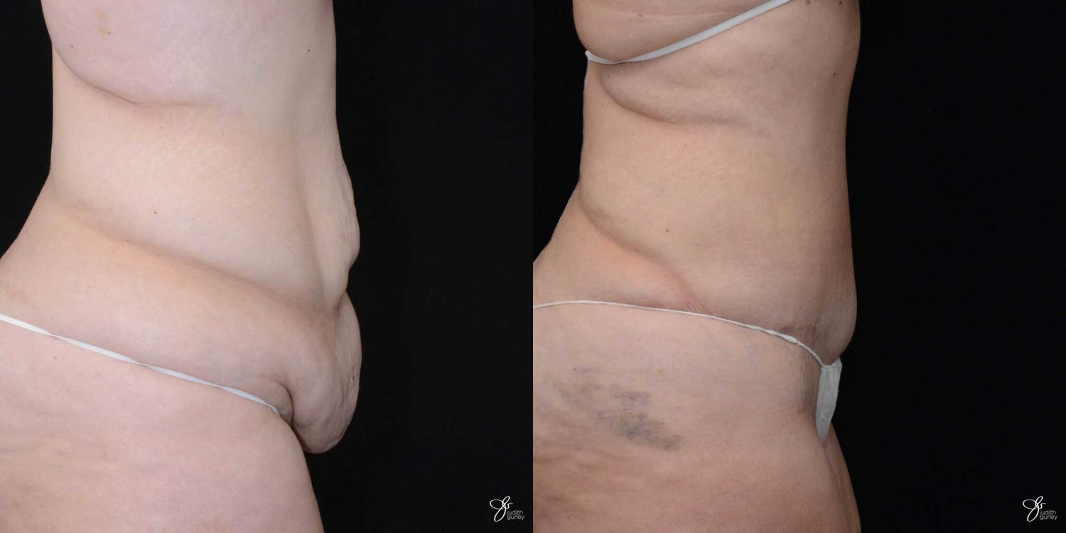 Body Lift Before & After