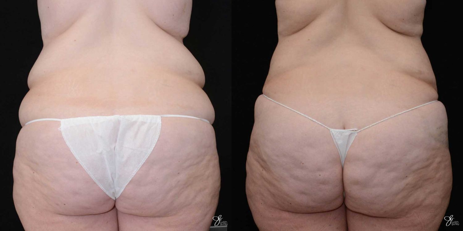 Body Lift Before & After