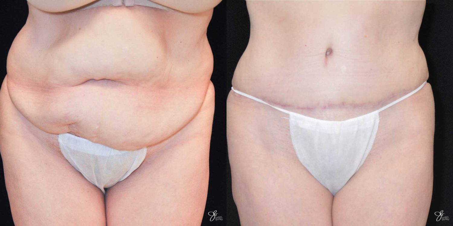 Body Lift Before & After