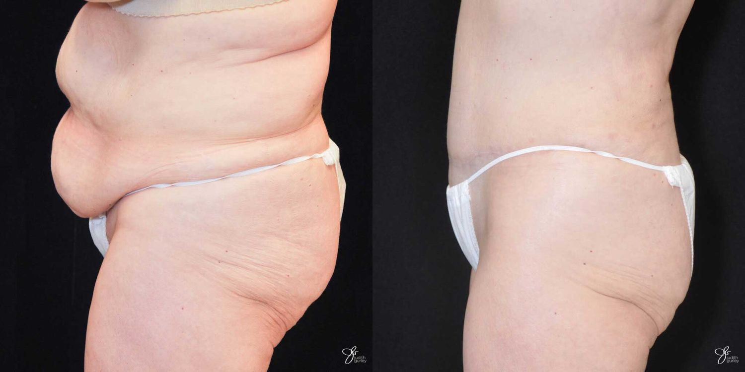 Body Lift Before & After