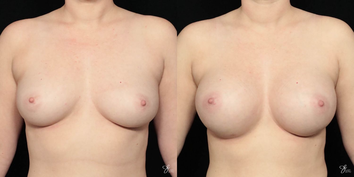 Breast Augmentation Before & After