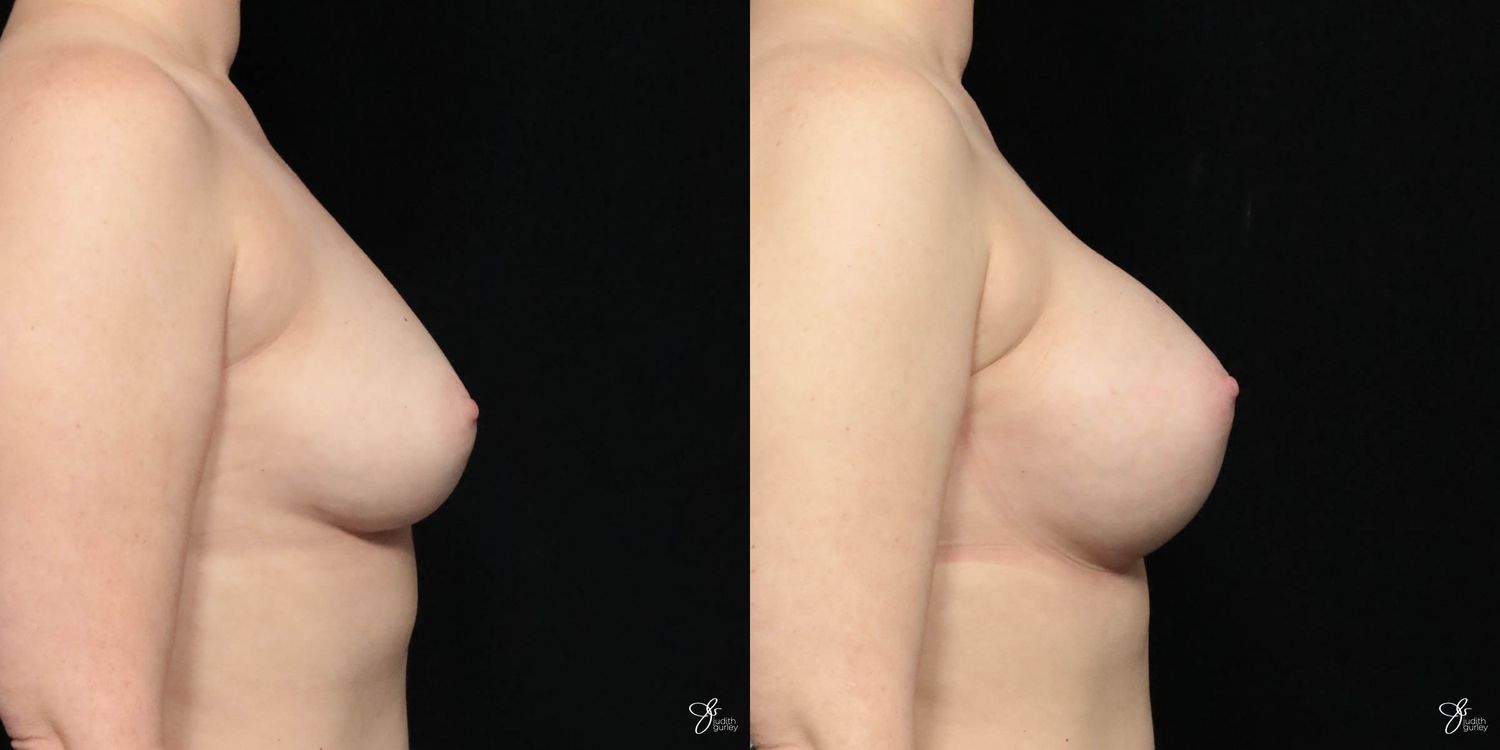 Breast Augmentation Before & After