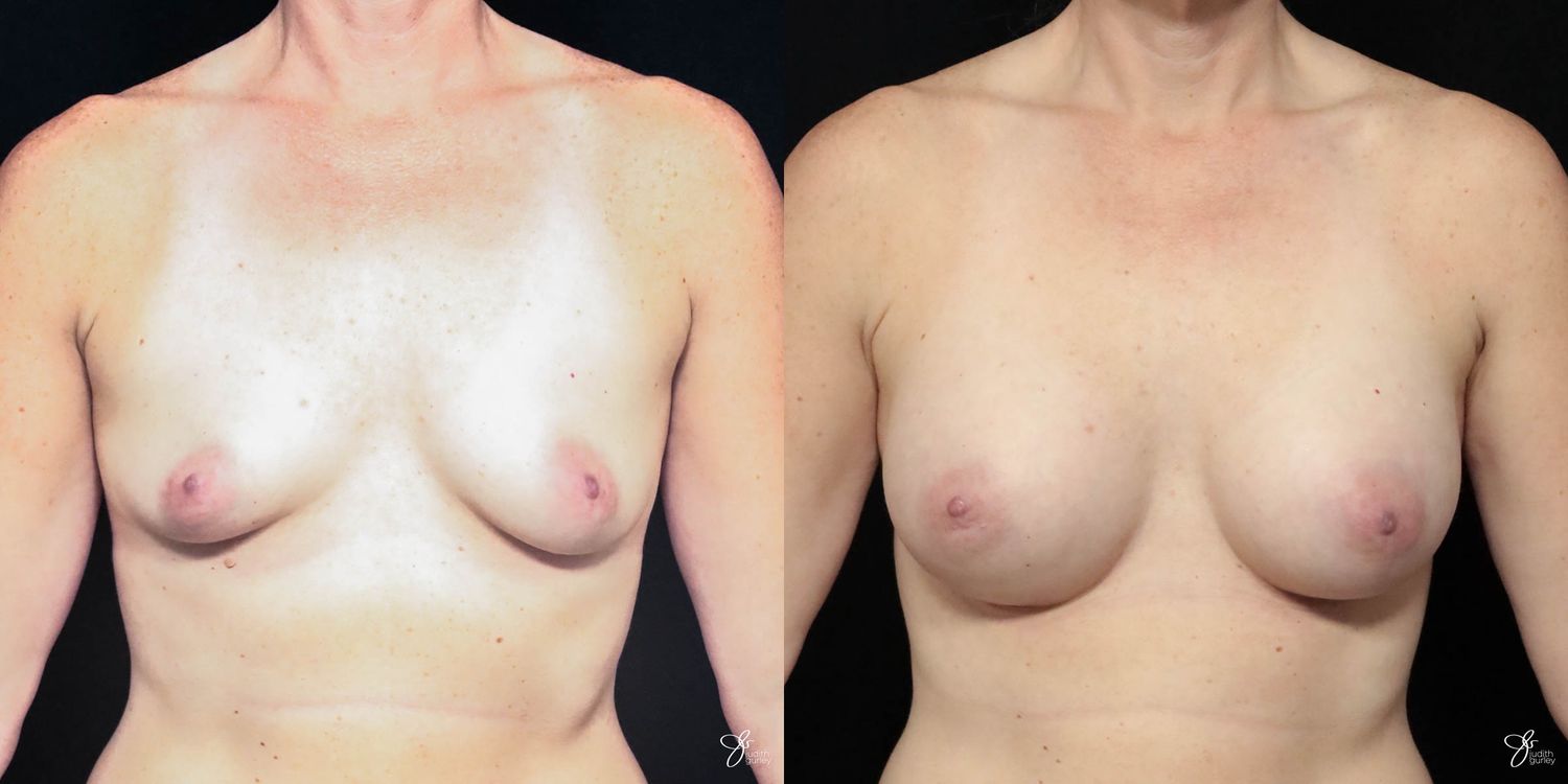 Breast Augmentation Before & After