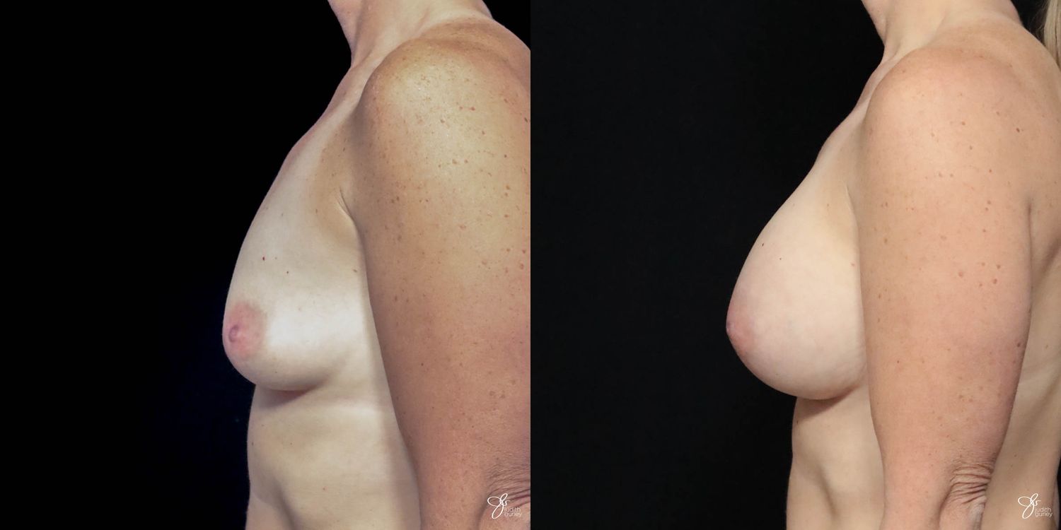 Breast Augmentation Before & After