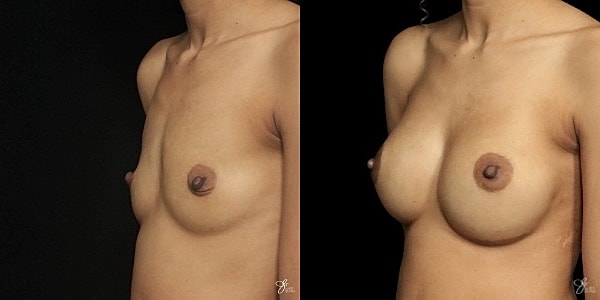 Breast Augmentation Before & After