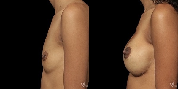 Breast Augmentation Before & After