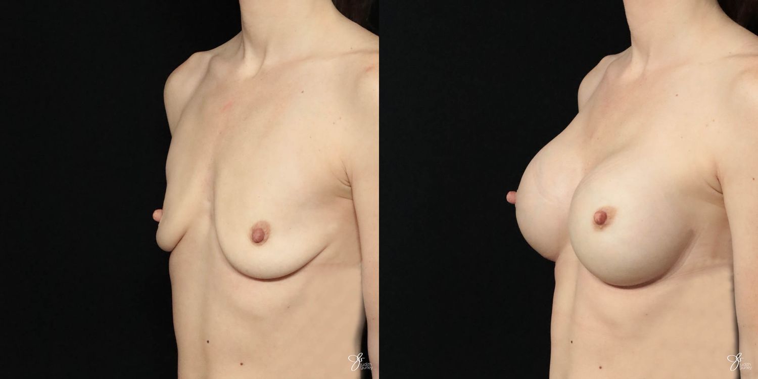 Breast Augmentation Before & After