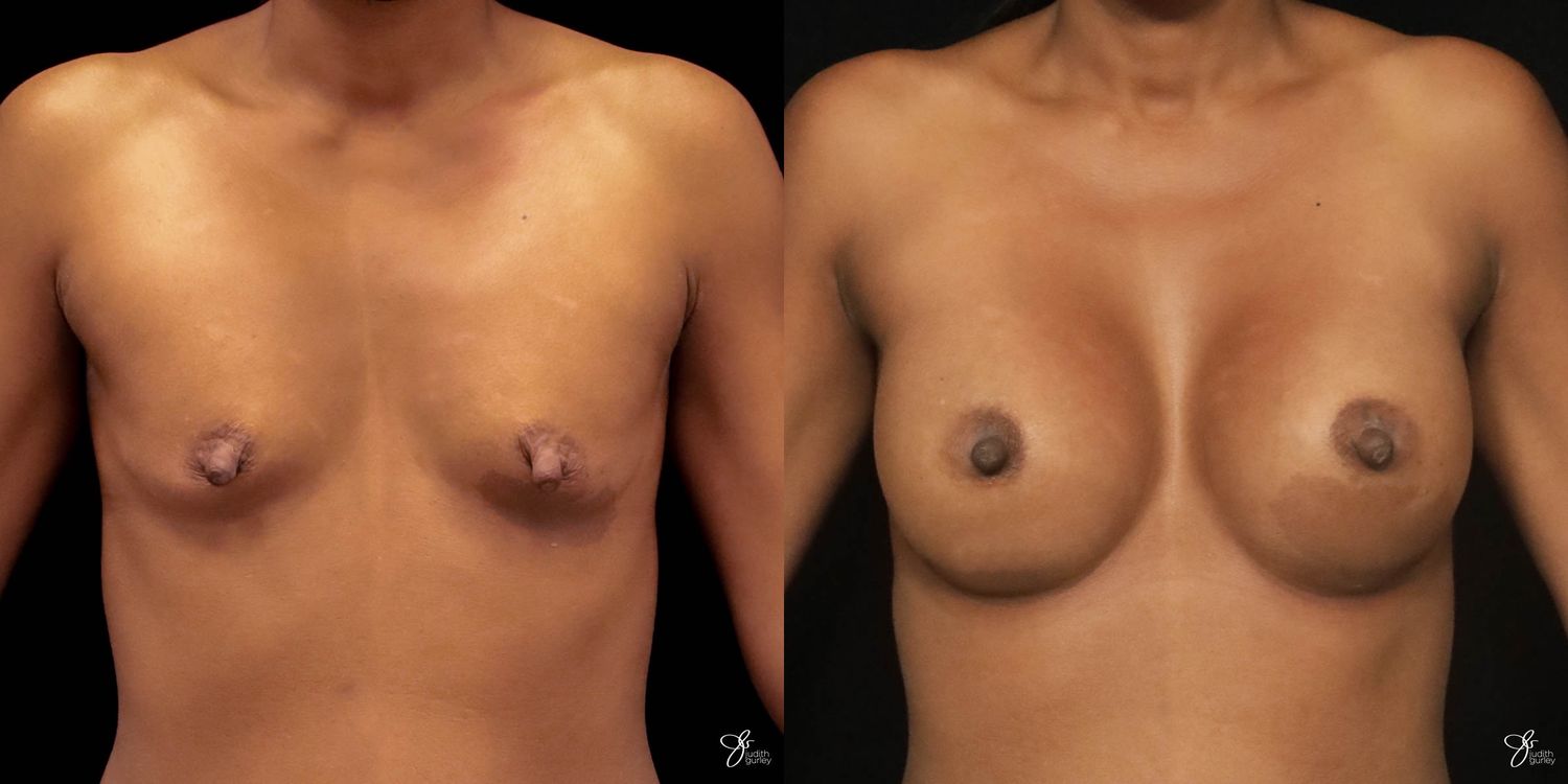 Breast Augmentation Before & After