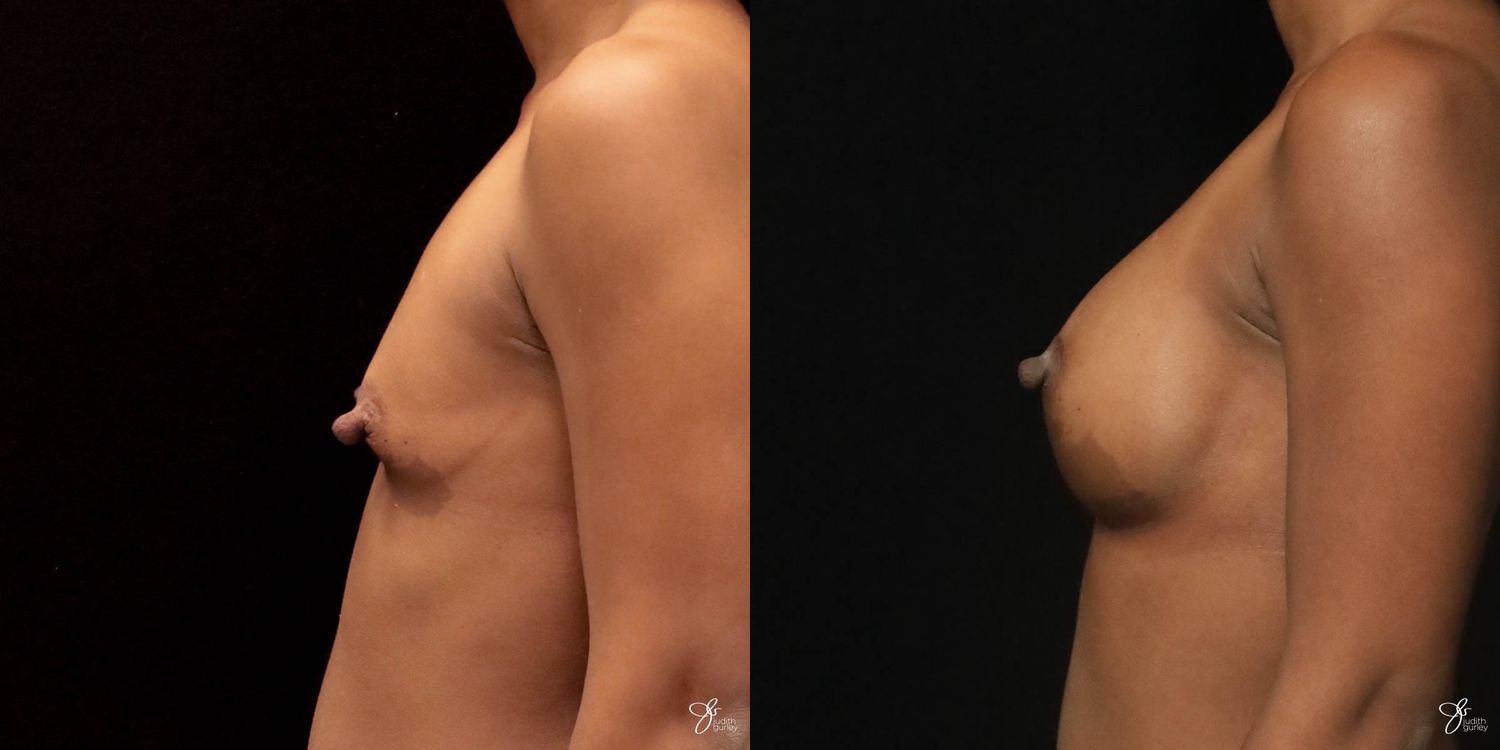 Breast Augmentation Before & After
