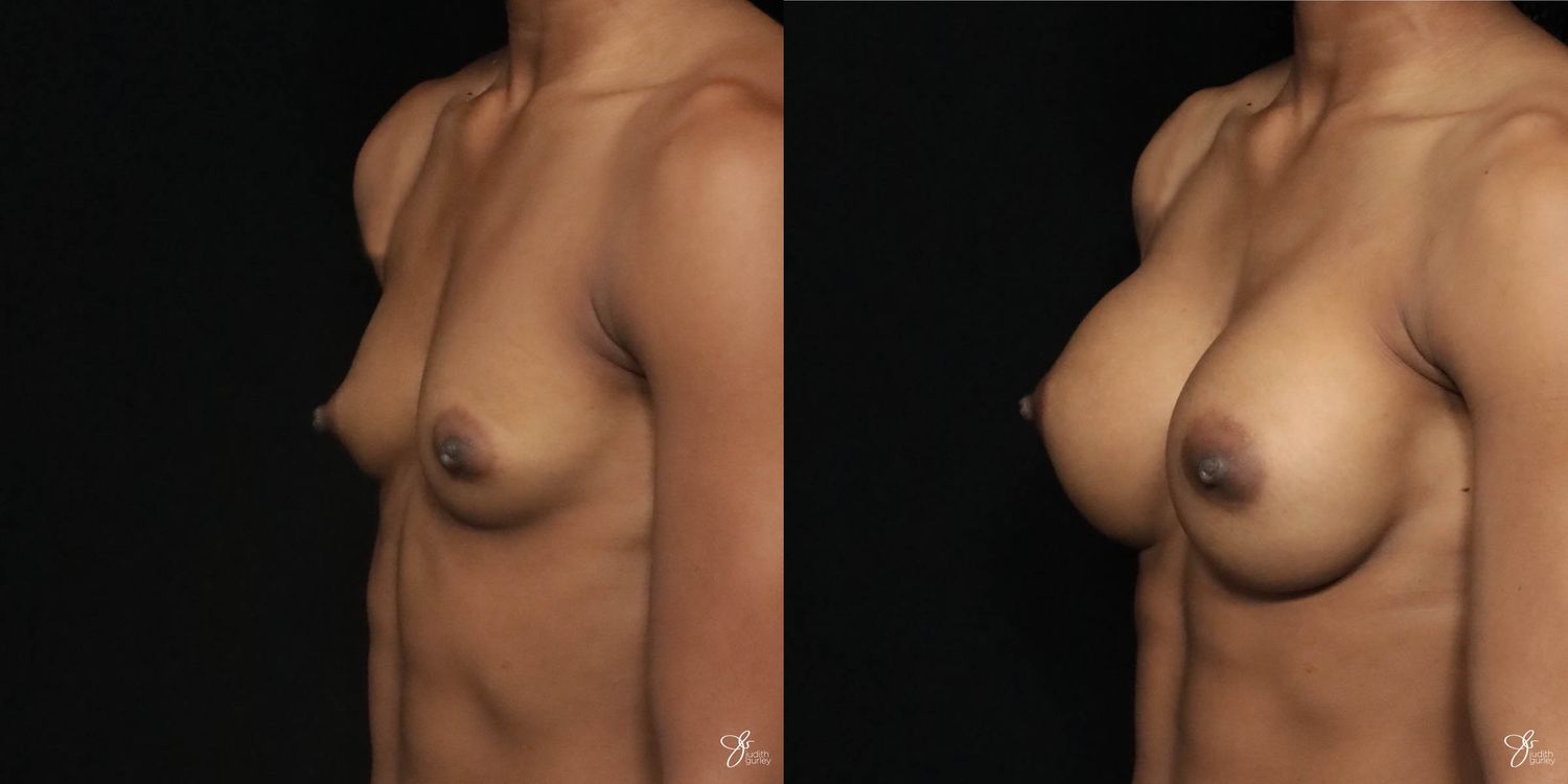 Breast Augmentation Before & After