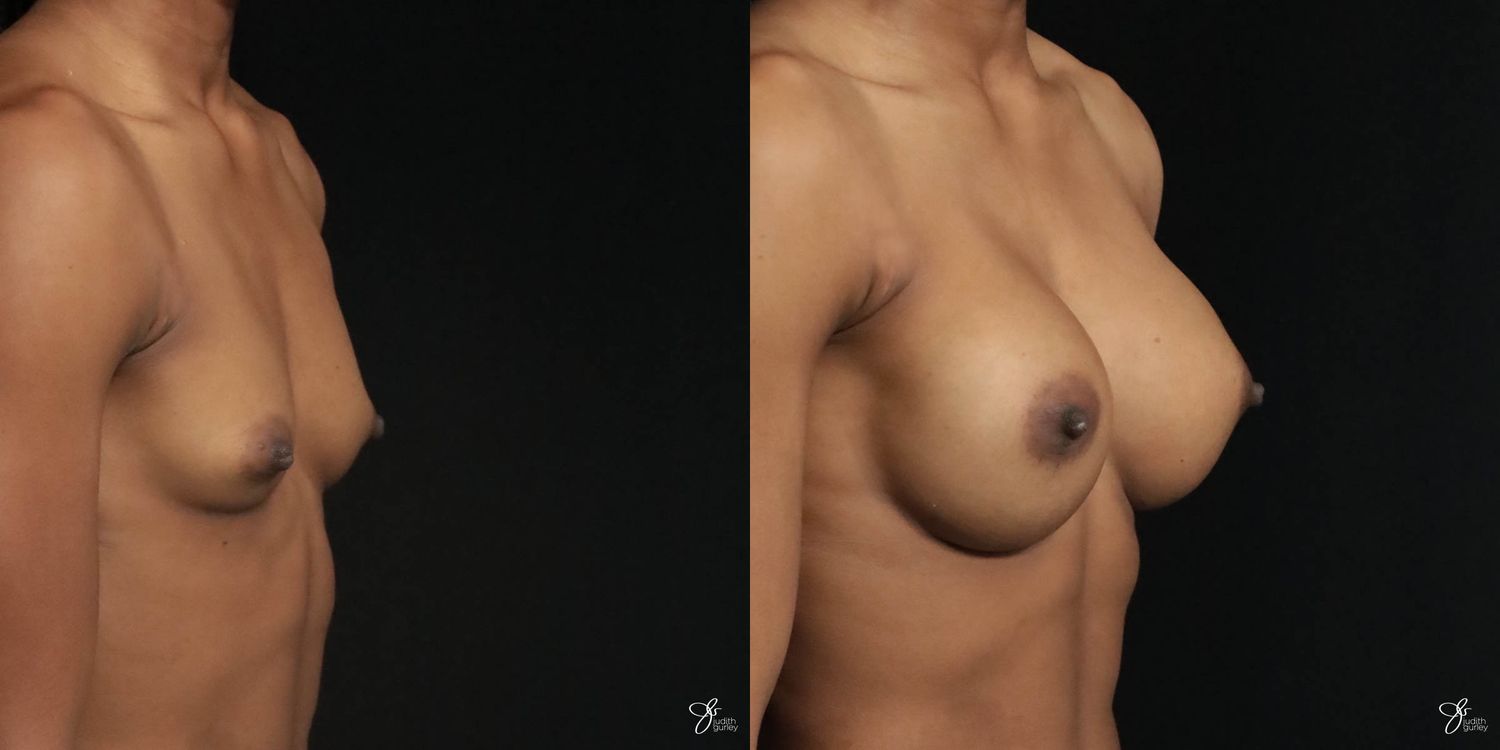 Breast Augmentation Before & After
