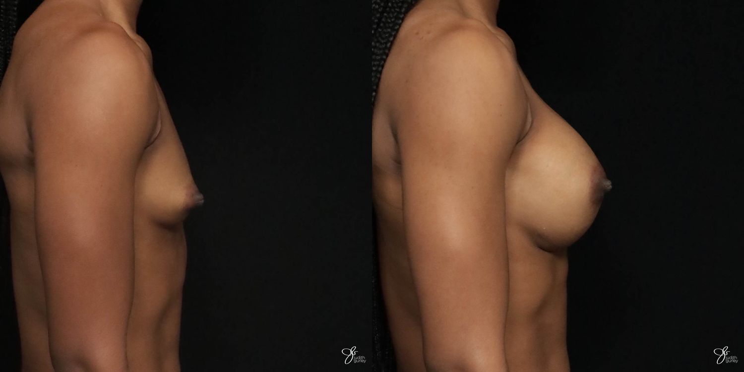 Breast Augmentation Before & After