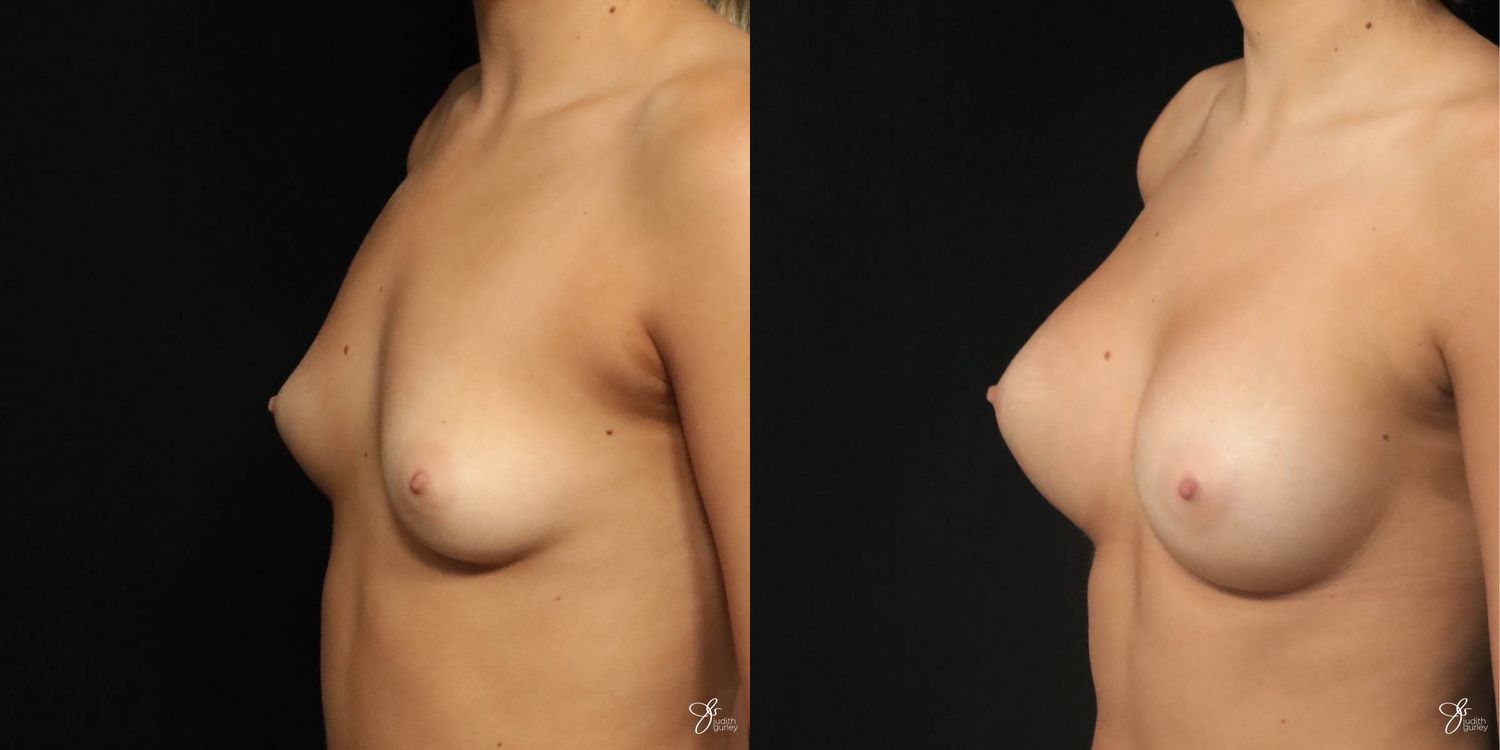 Breast Augmentation Before & After