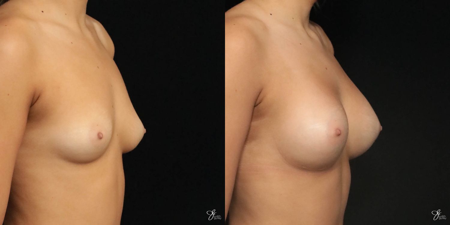 Breast Augmentation Before & After