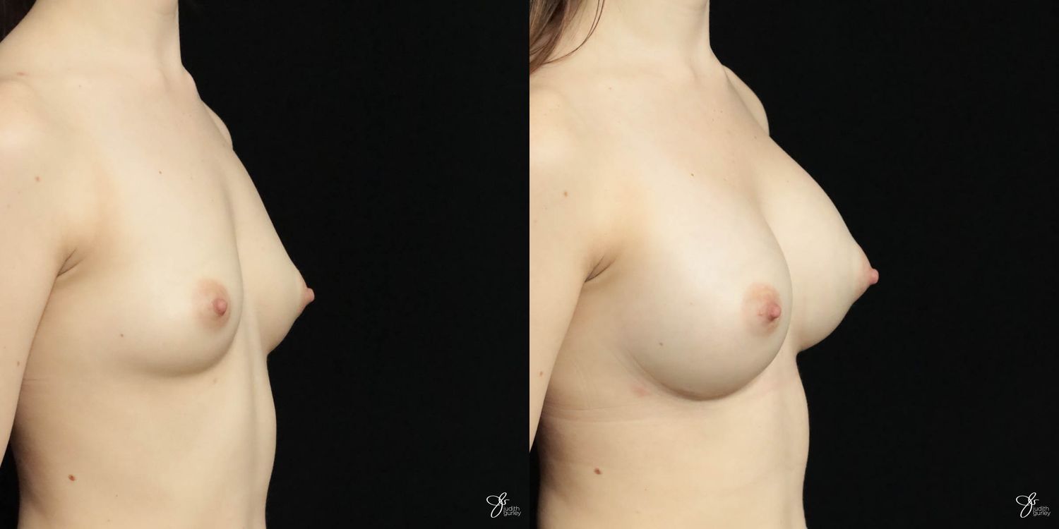 Breast Augmentation Before & After