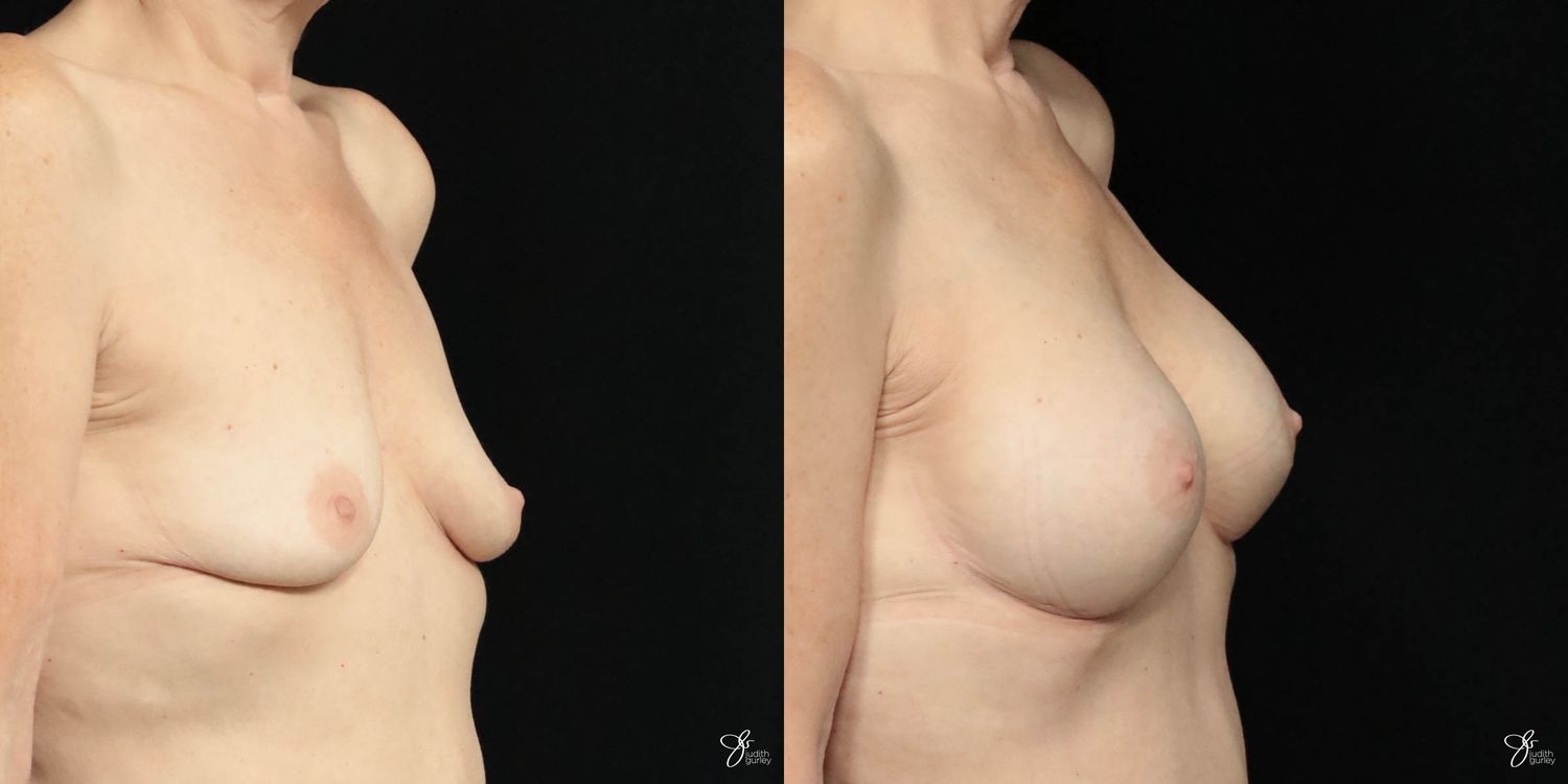 Breast Augmentation Before & After