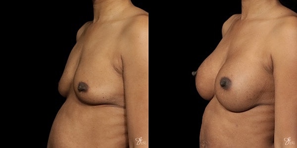 Breast Augmentation Before & After