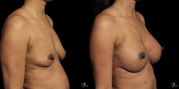 Breast Augmentation Before & After