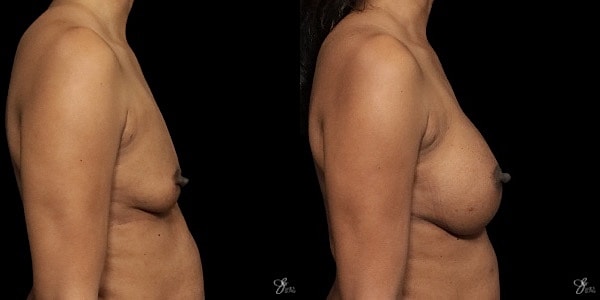 Breast Augmentation Before & After