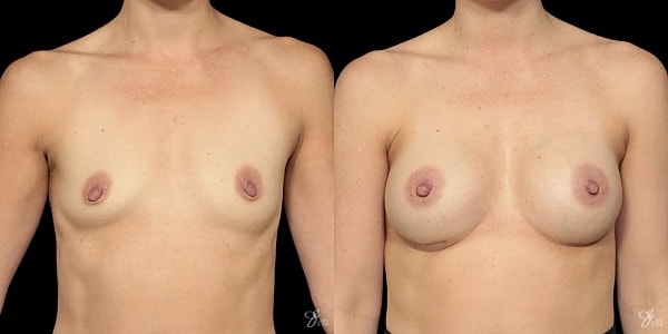 Breast Augmentation Before & After
