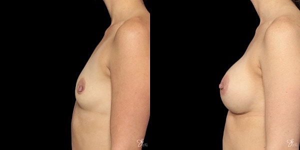 Breast Augmentation Before & After