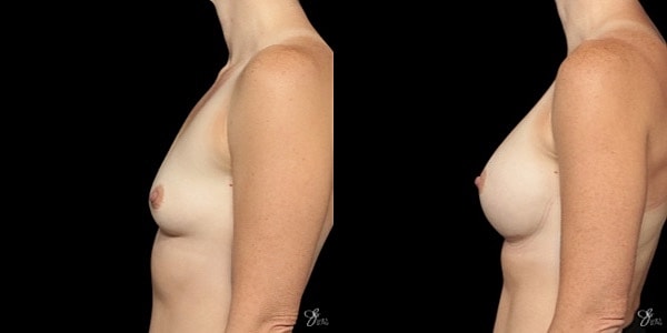 Breast Augmentation Before & After
