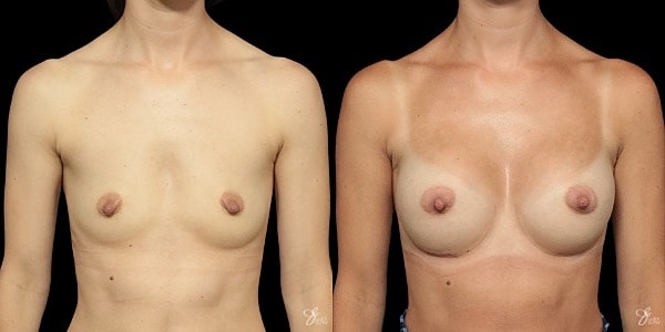 Breast Augmentation Before & After
