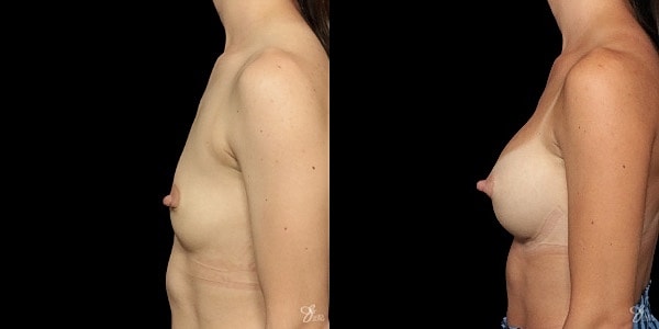 Breast Augmentation Before & After