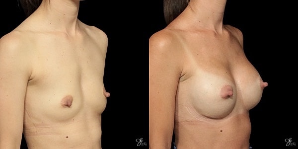 Breast Augmentation Before & After