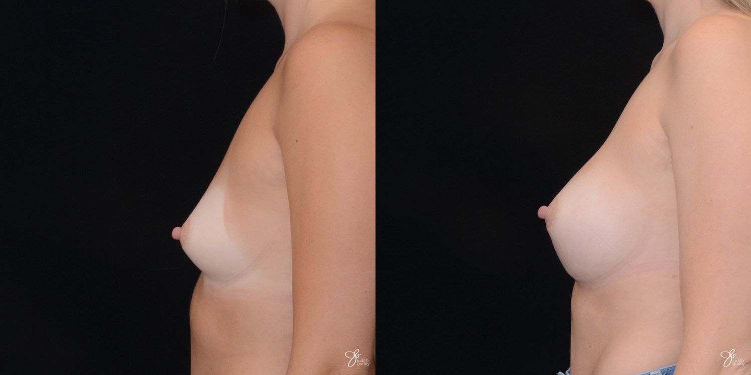 Breast Augmentation Before & After