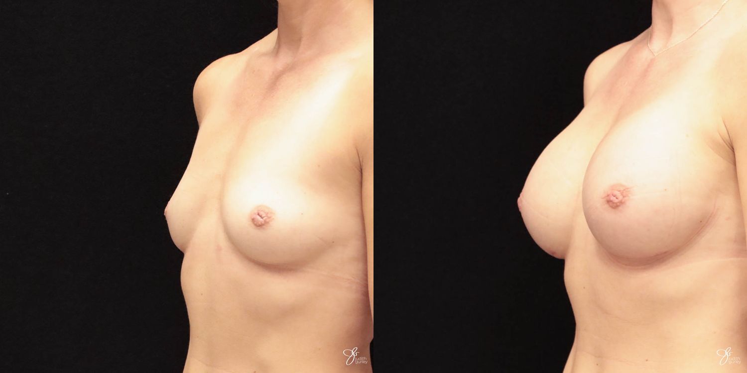 Breast Augmentation Before & After