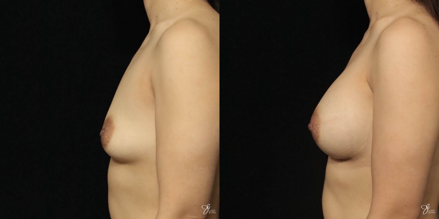 Breast Augmentation Before & After