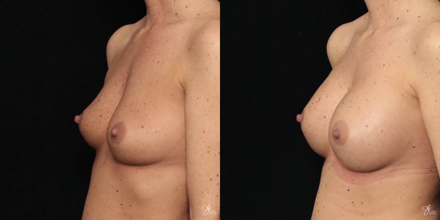 Breast Augmentation Before & After