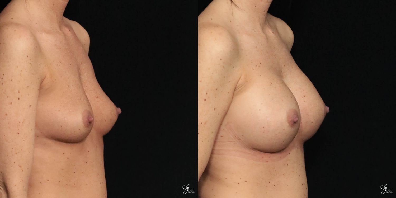 Breast Augmentation Before & After