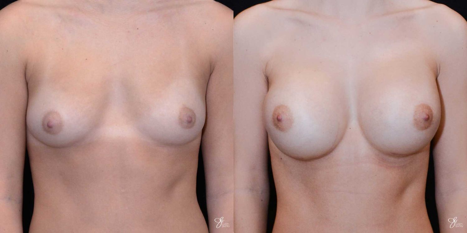 Breast Augmentation Before & After