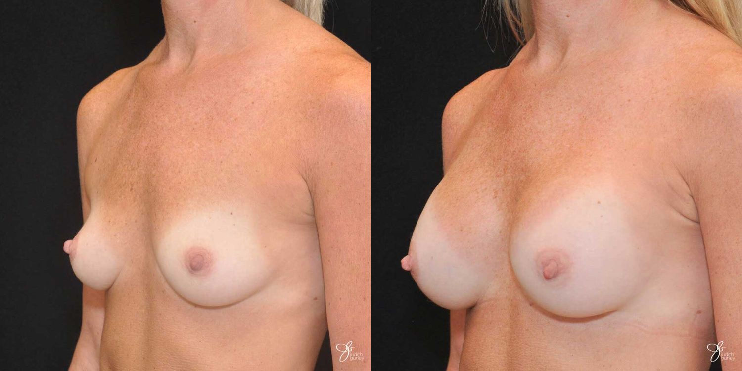 Breast Augmentation Before & After