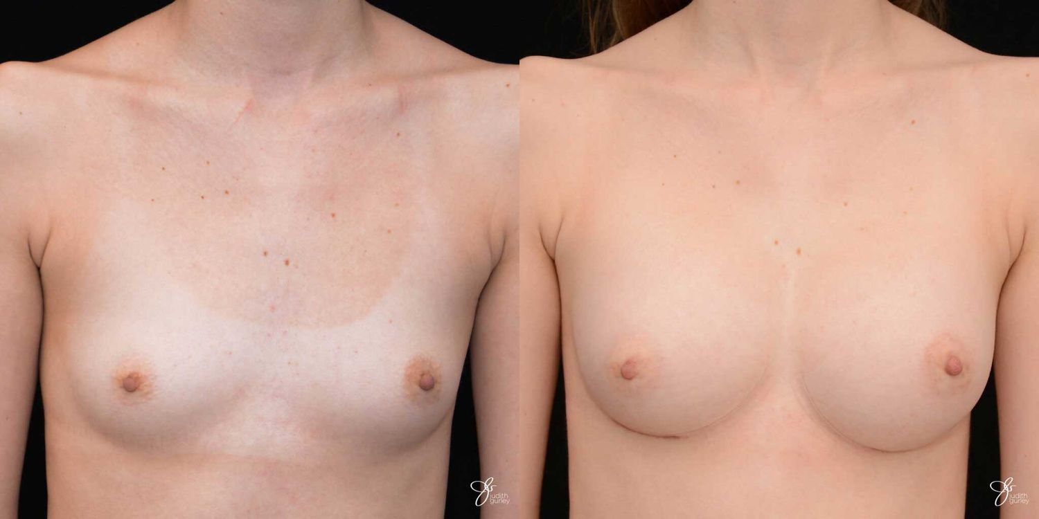 Breast Augmentation Before & After