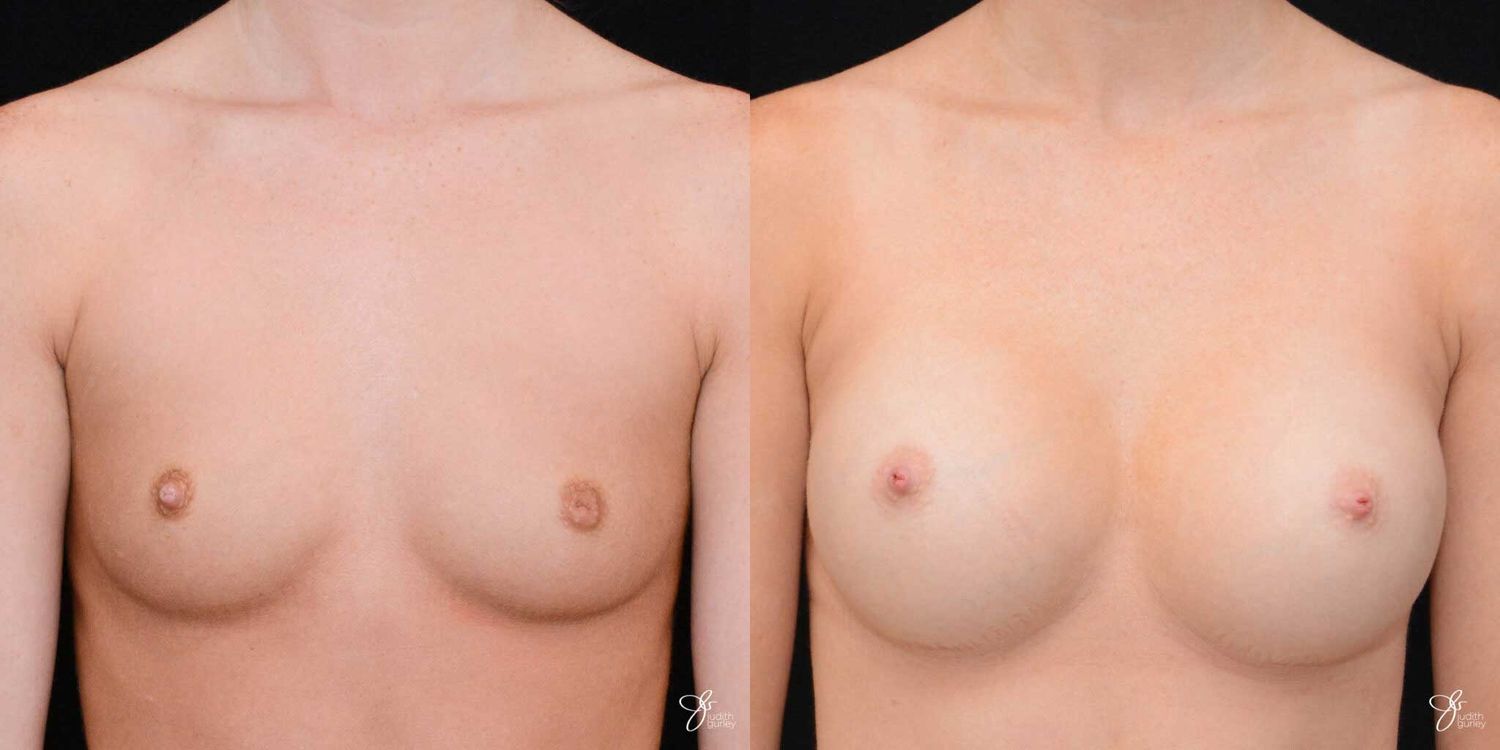 Breast Augmentation Before & After