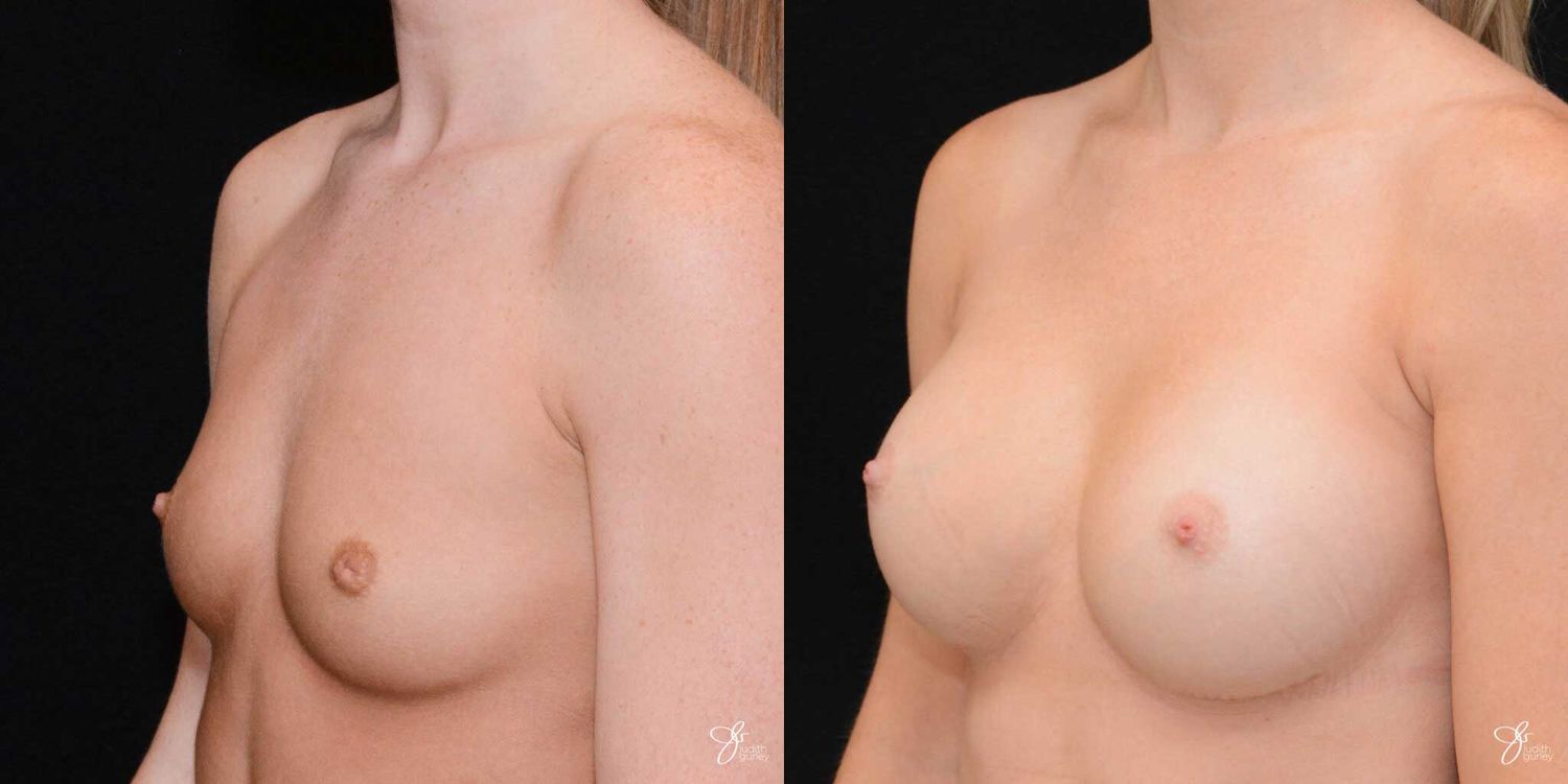 Breast Augmentation Before & After