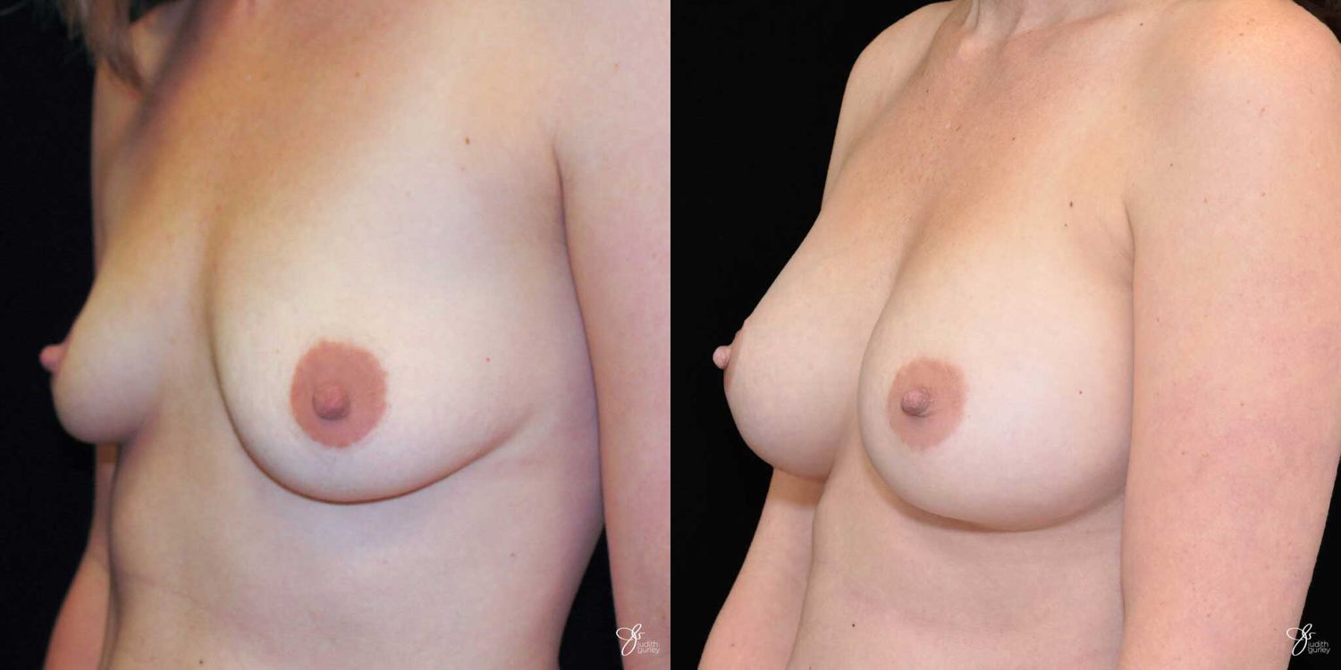 Breast Augmentation Before & After