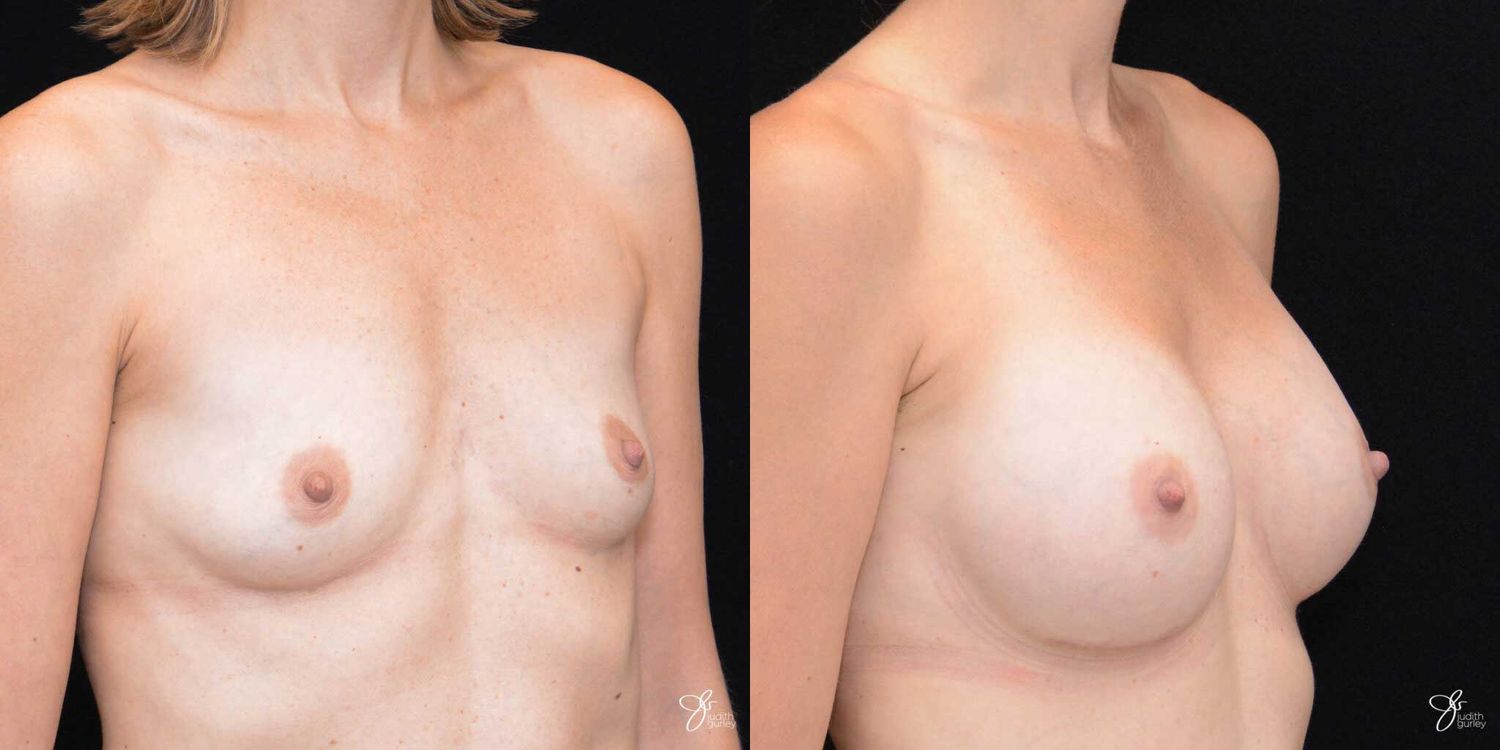 Breast Augmentation Before & After