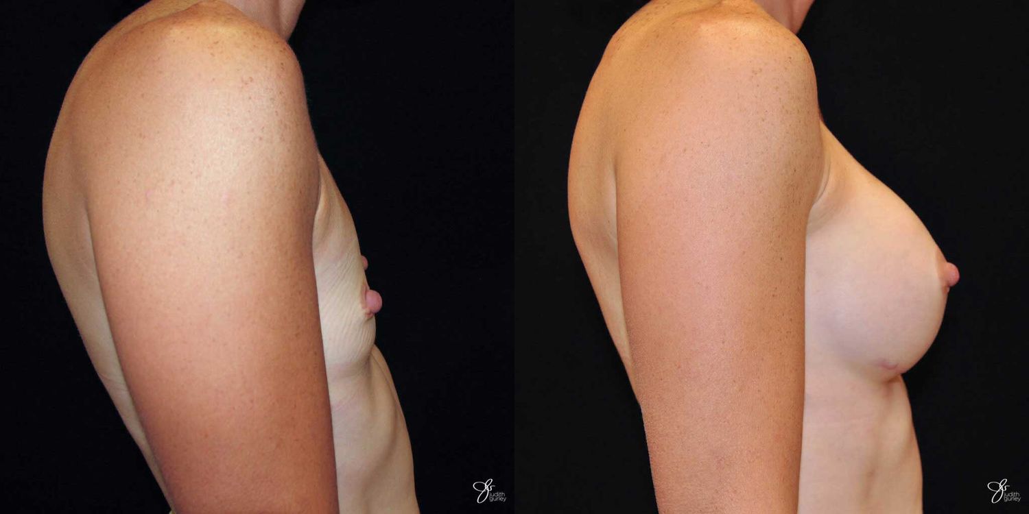 Breast Augmentation Before & After