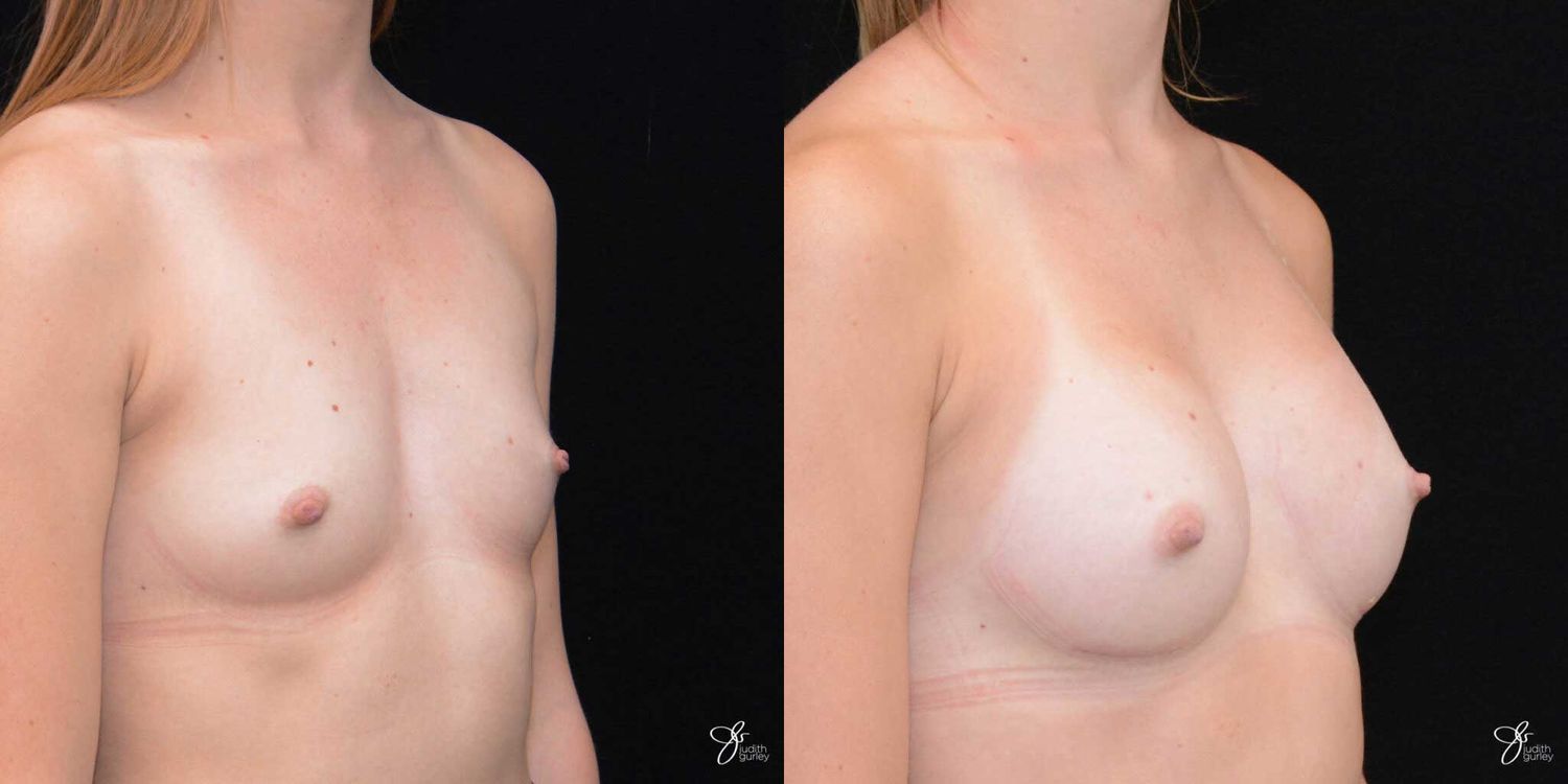 Breast Augmentation Before & After
