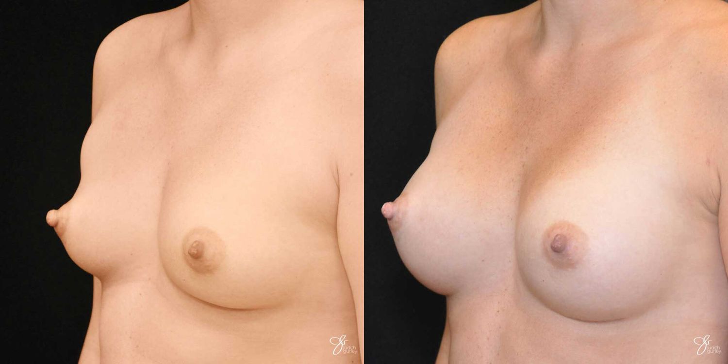 Breast Augmentation Before & After